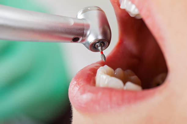 Best Emergency Tooth Extraction in Pittston, PA